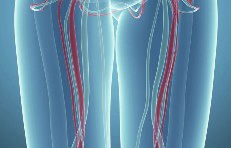 Peripheral Arterial Disease (PAD) 