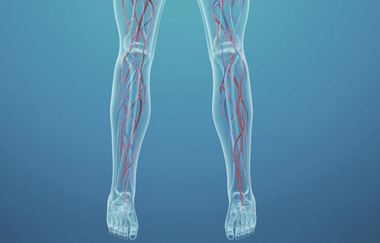 Peripheral Arterial Disease (PAD) 